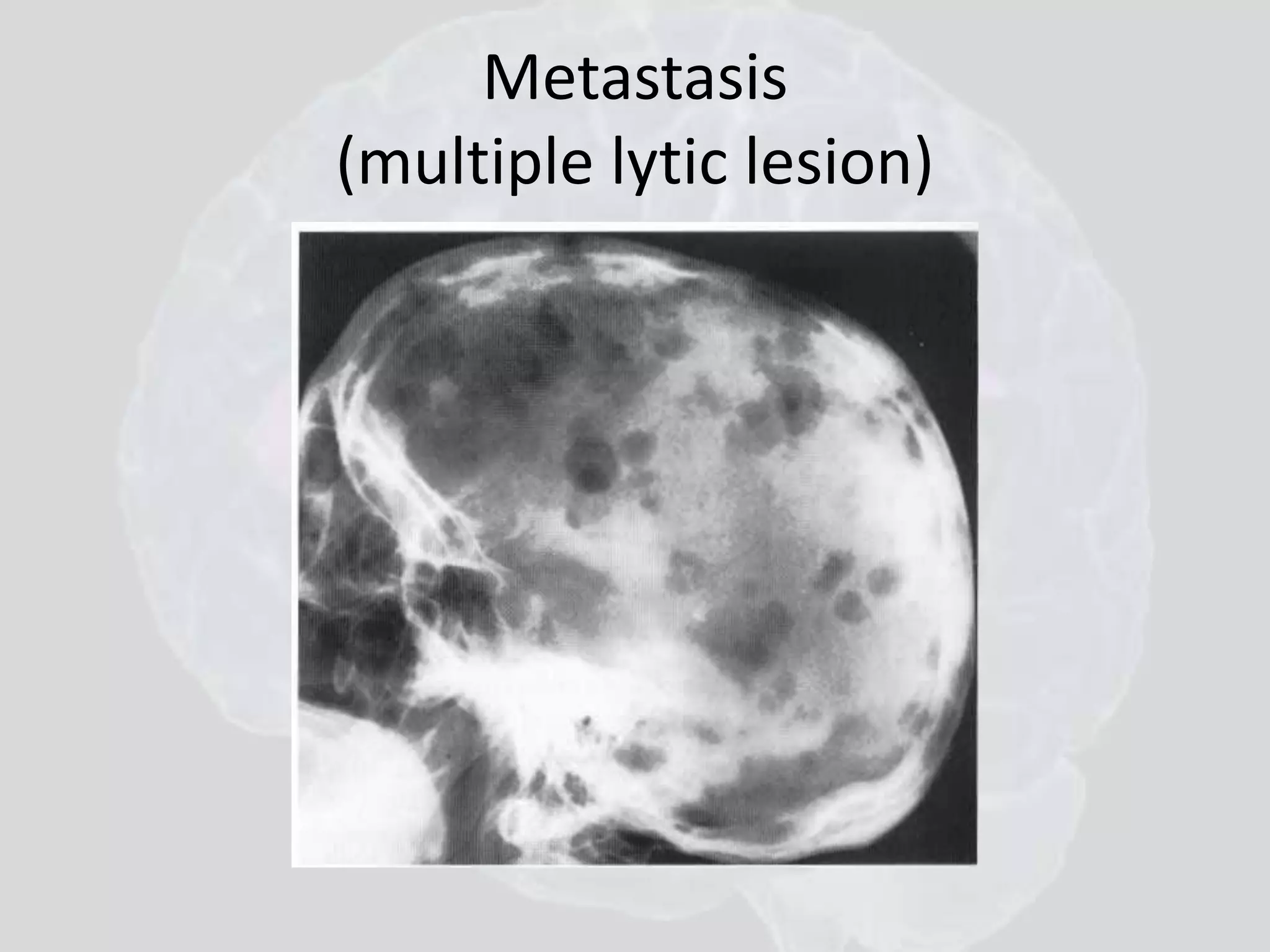 Metastasis 
(multiple lytic lesion) 
 