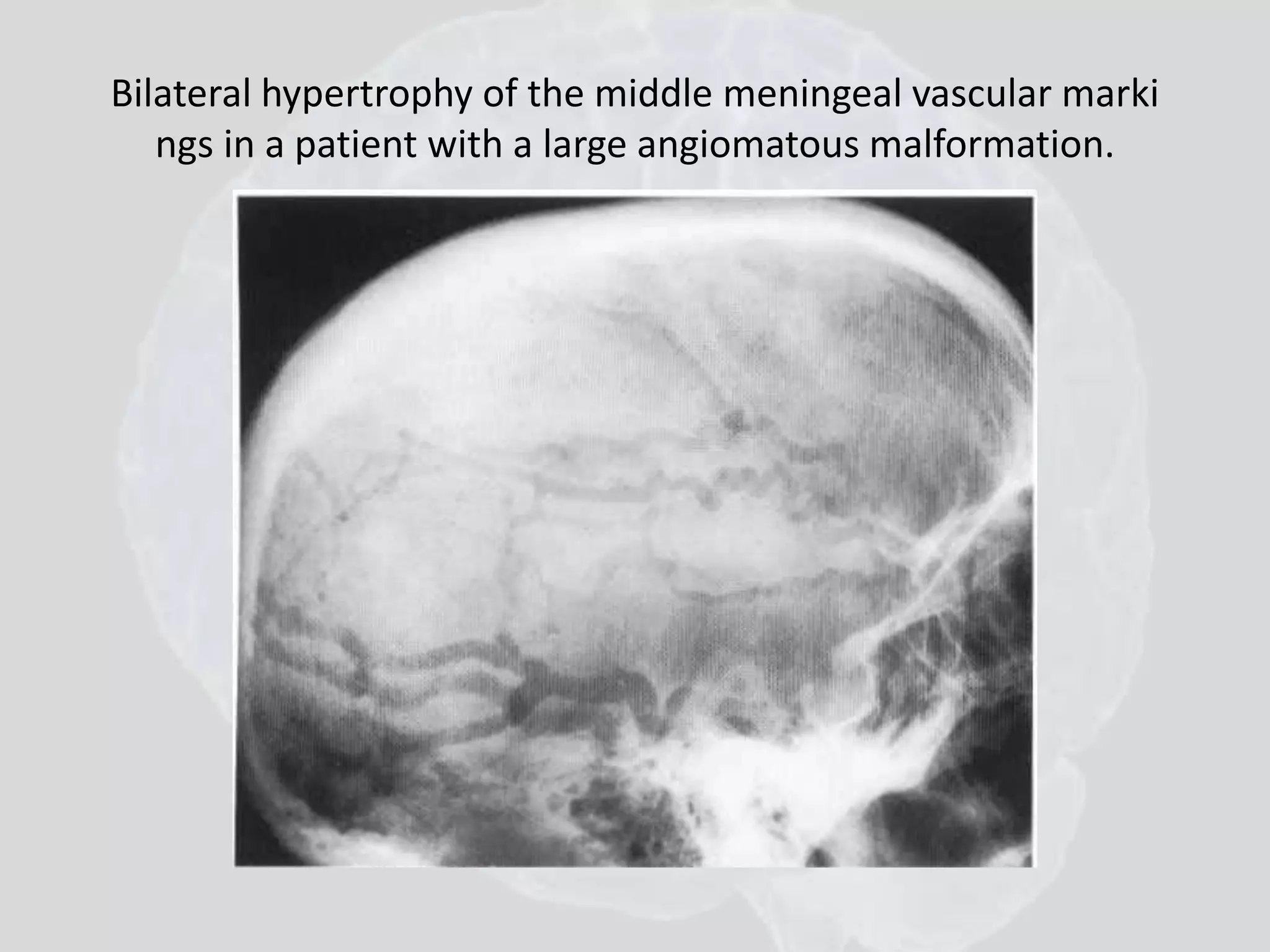 Bilateral hypertrophy of the middle meningeal vascular marki 
ngs in a patient with a large angiomatous malformation. 
 