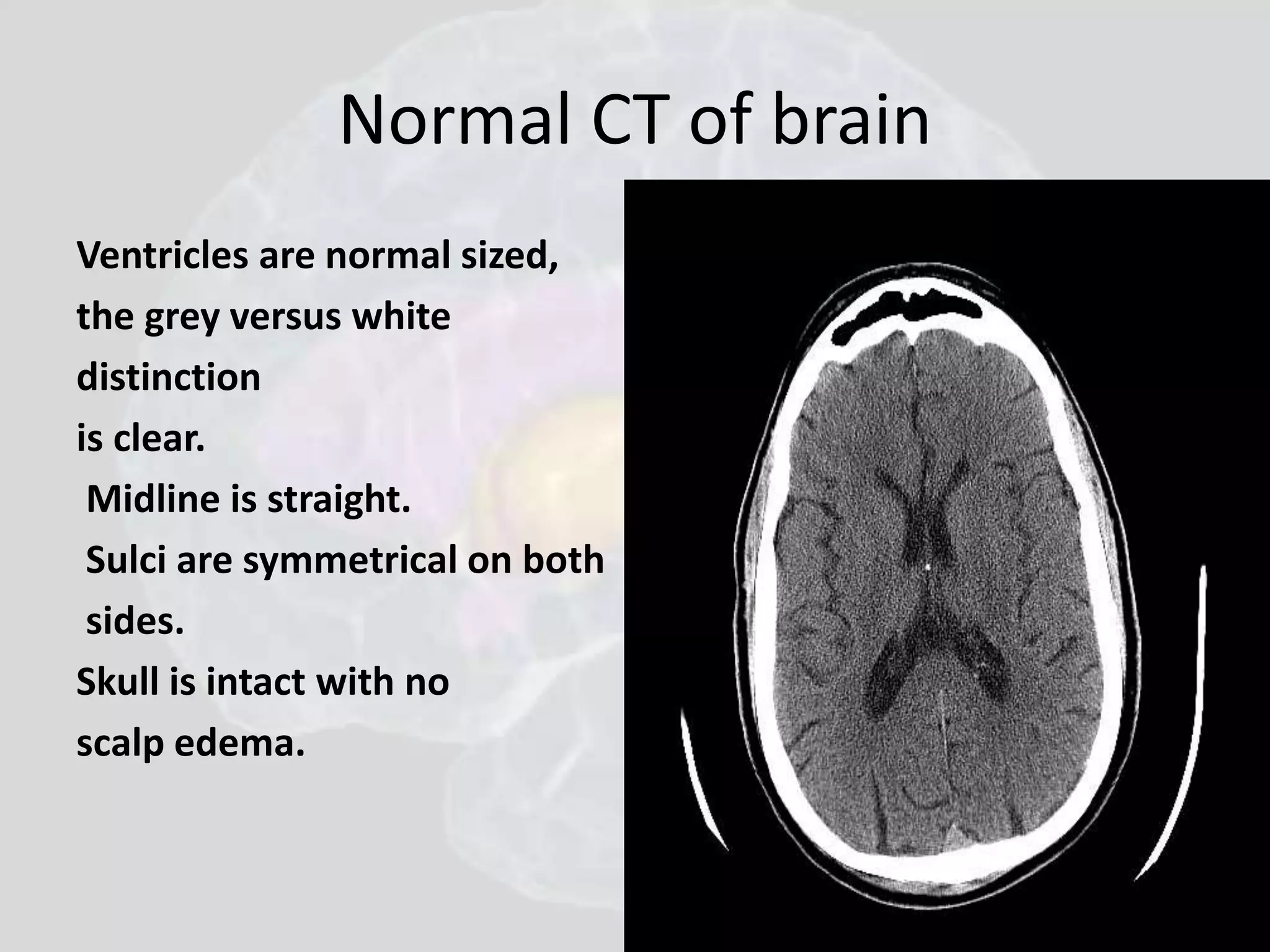 Normal CT of brain 
Ventricles are normal sized, 
the grey versus white 
distinction 
is clear. 
Midline is straight. 
Sulci are symmetrical on both 
sides. 
Skull is intact with no 
scalp edema. 
 
