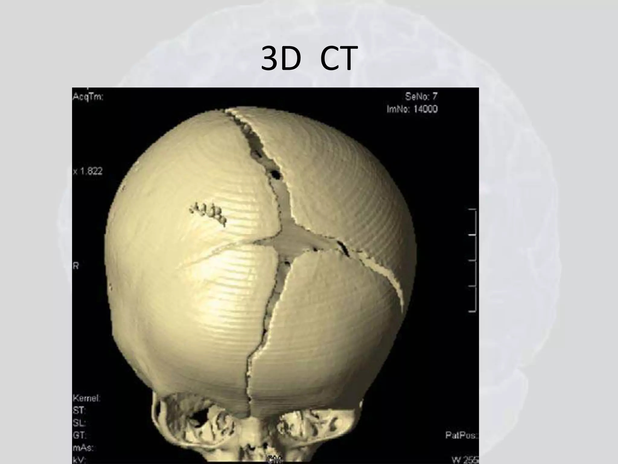 3D CT 
 