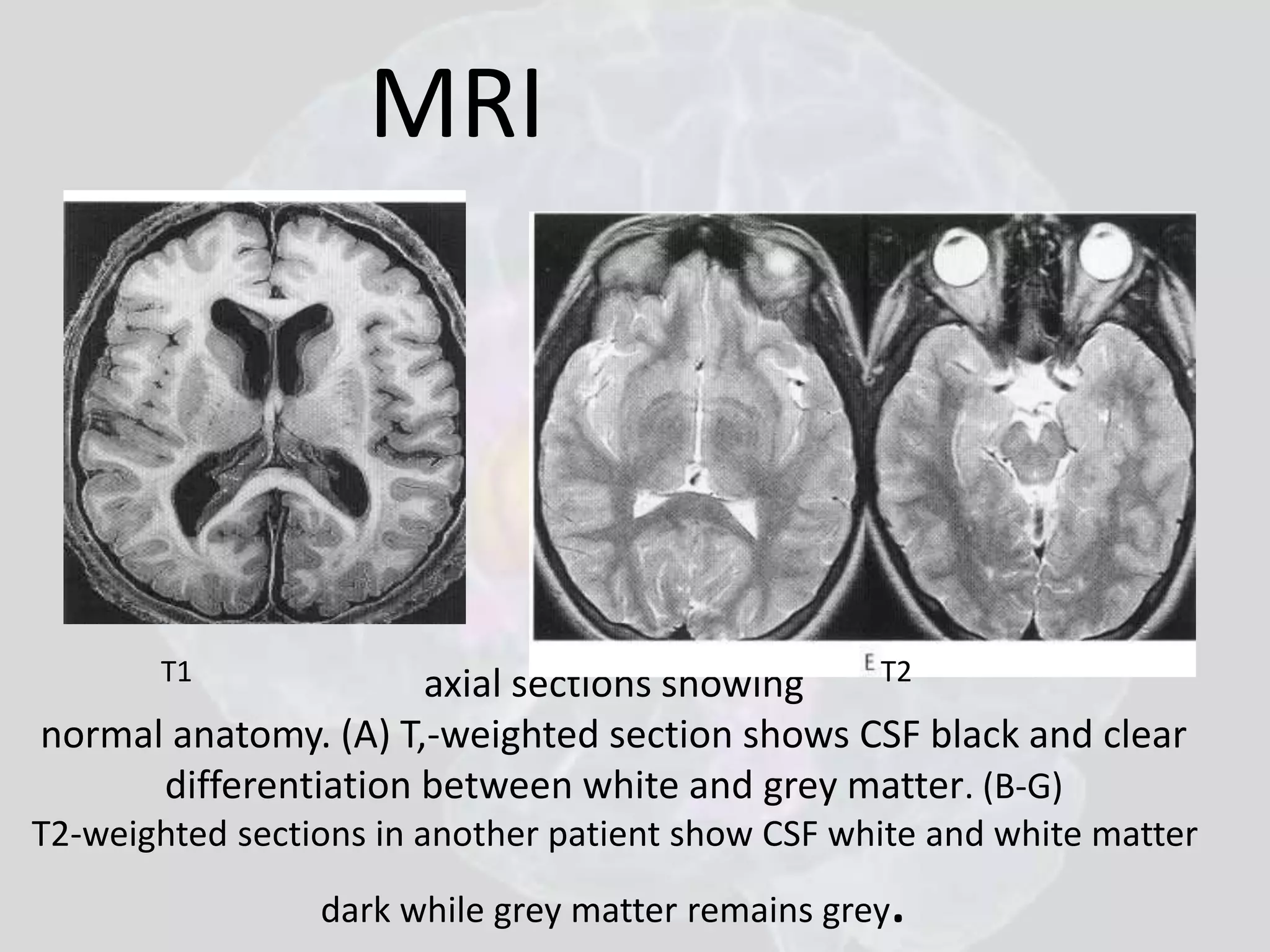 MRI 
T1 T2 
axial sections showing 
normal anatomy. (A) T,-weighted section shows CSF black and clear 
differentiation between white and grey matter. (B-G) 
T2-weighted sections in another patient show CSF white and white matter 
dark while grey matter remains grey. 
 