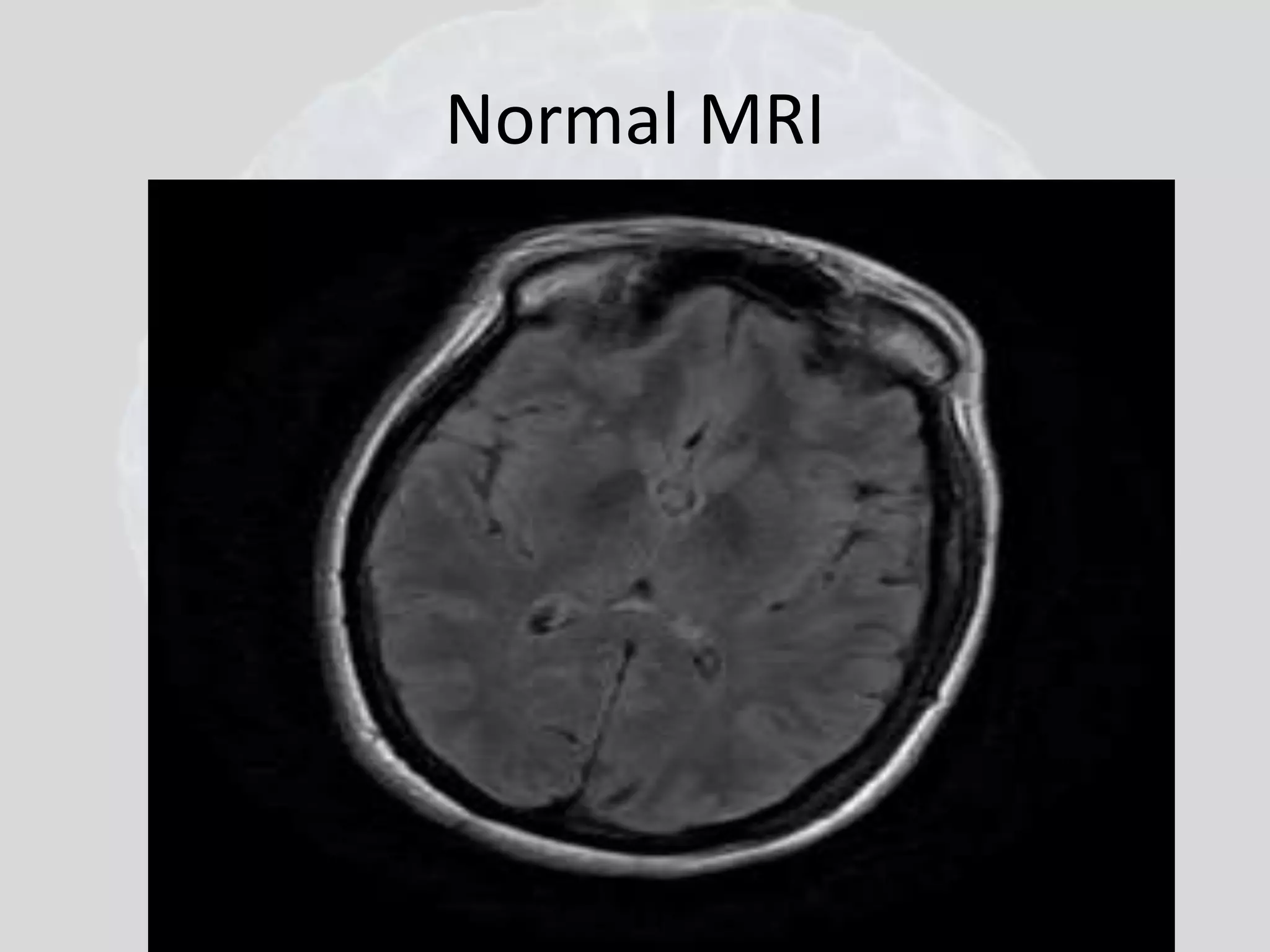 Normal MRI 
 