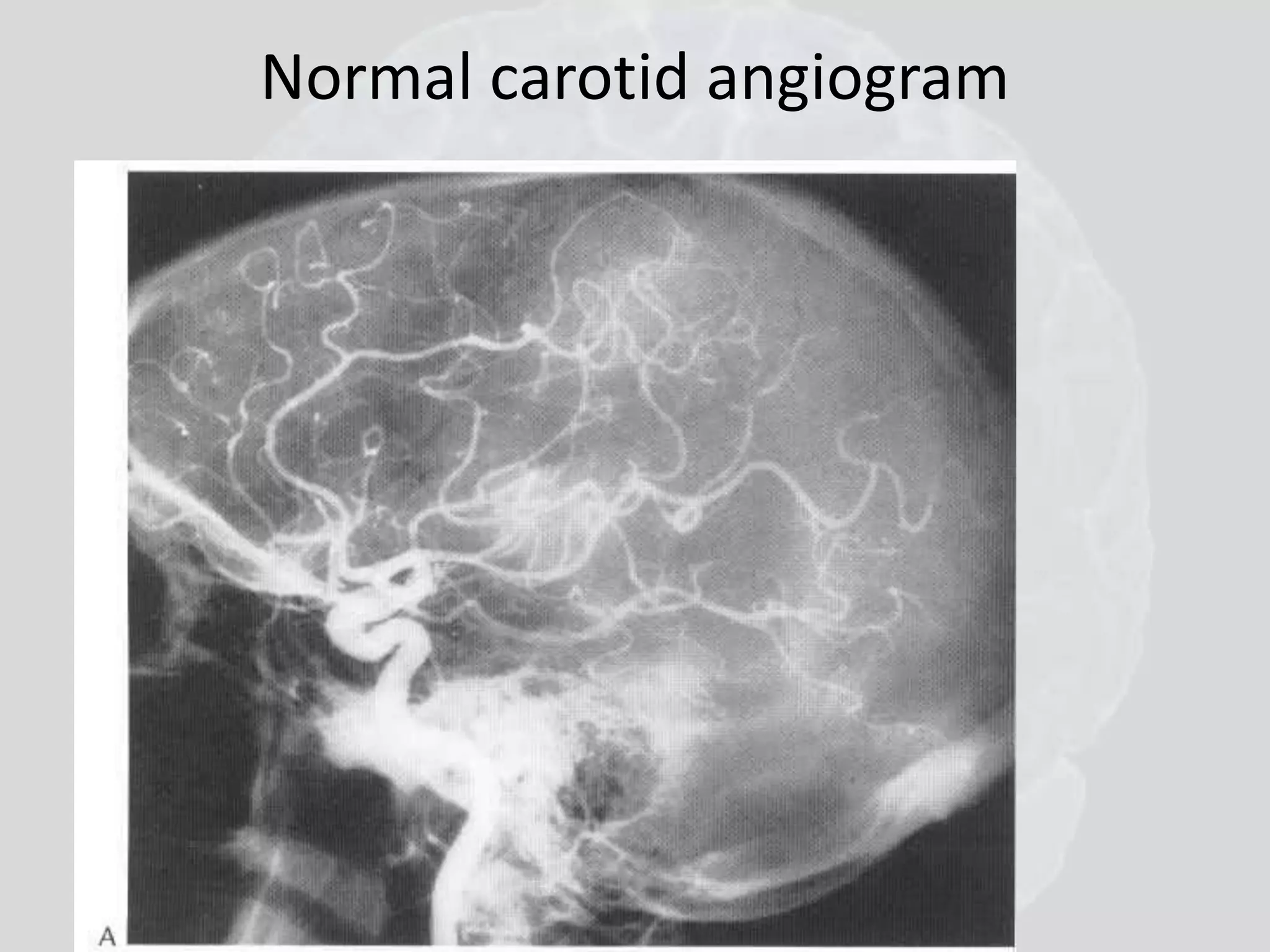 Normal carotid angiogram 
 