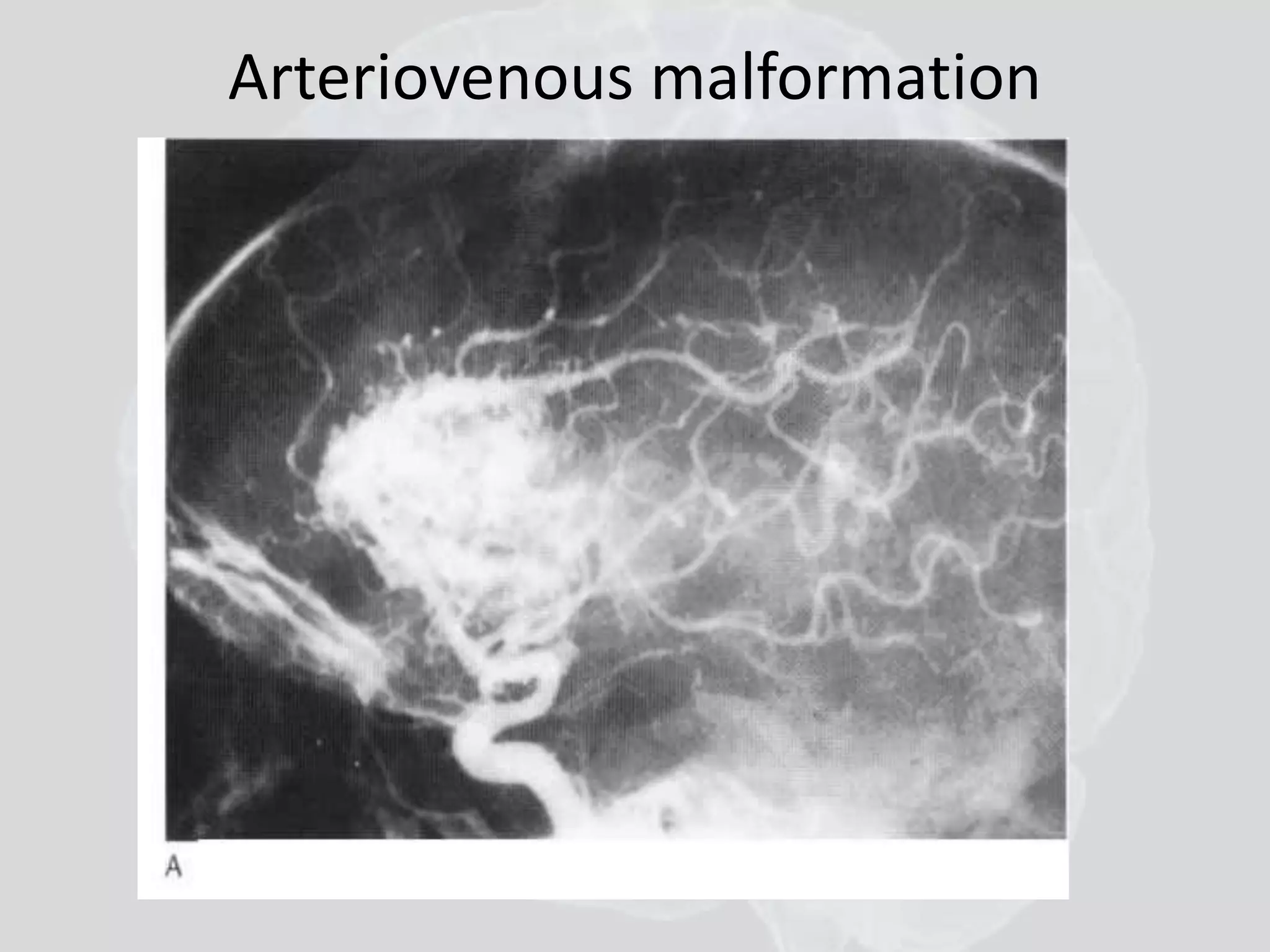 Arteriovenous malformation 
 