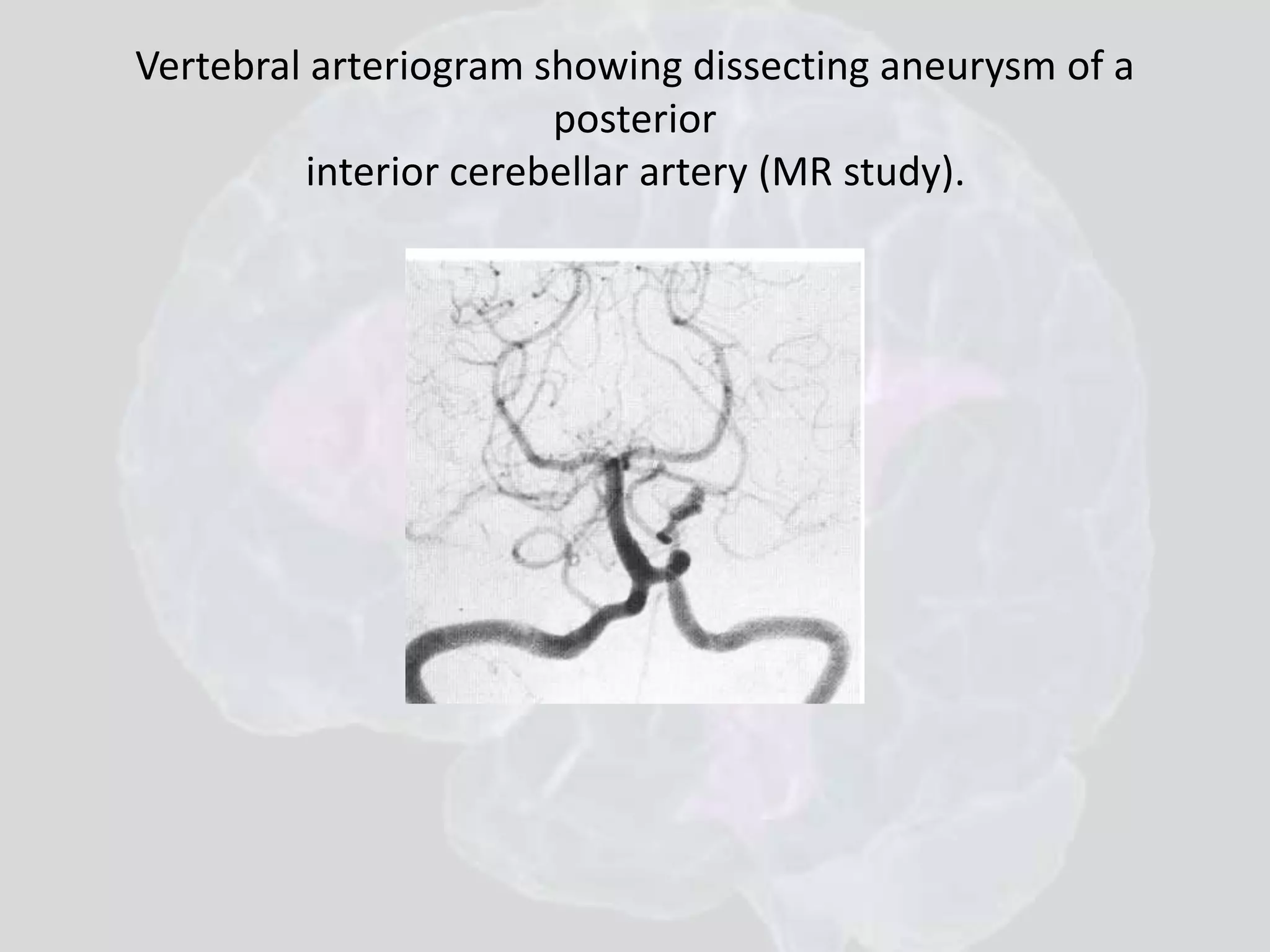 Vertebral arteriogram showing dissecting aneurysm of a 
posterior 
interior cerebellar artery (MR study). 
 