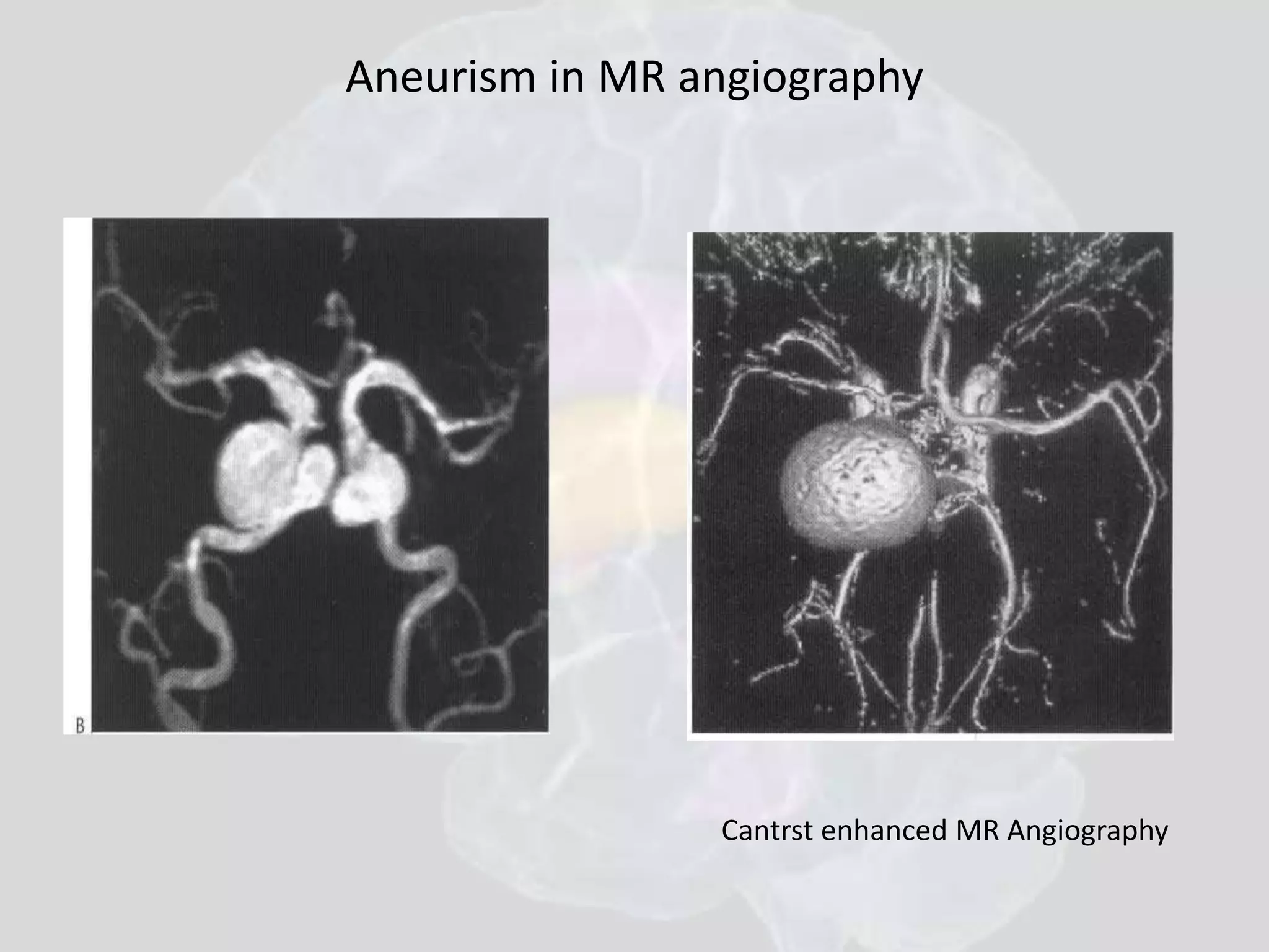 Aneurism in MR angiography 
Cantrst enhanced MR Angiography 
 