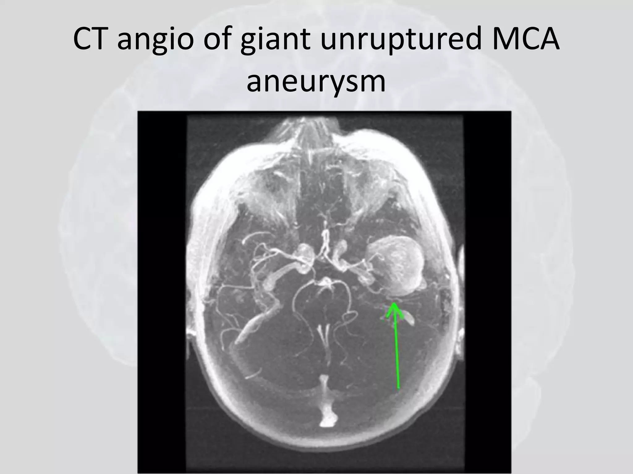 CT angio of giant unruptured MCA 
aneurysm 
 
