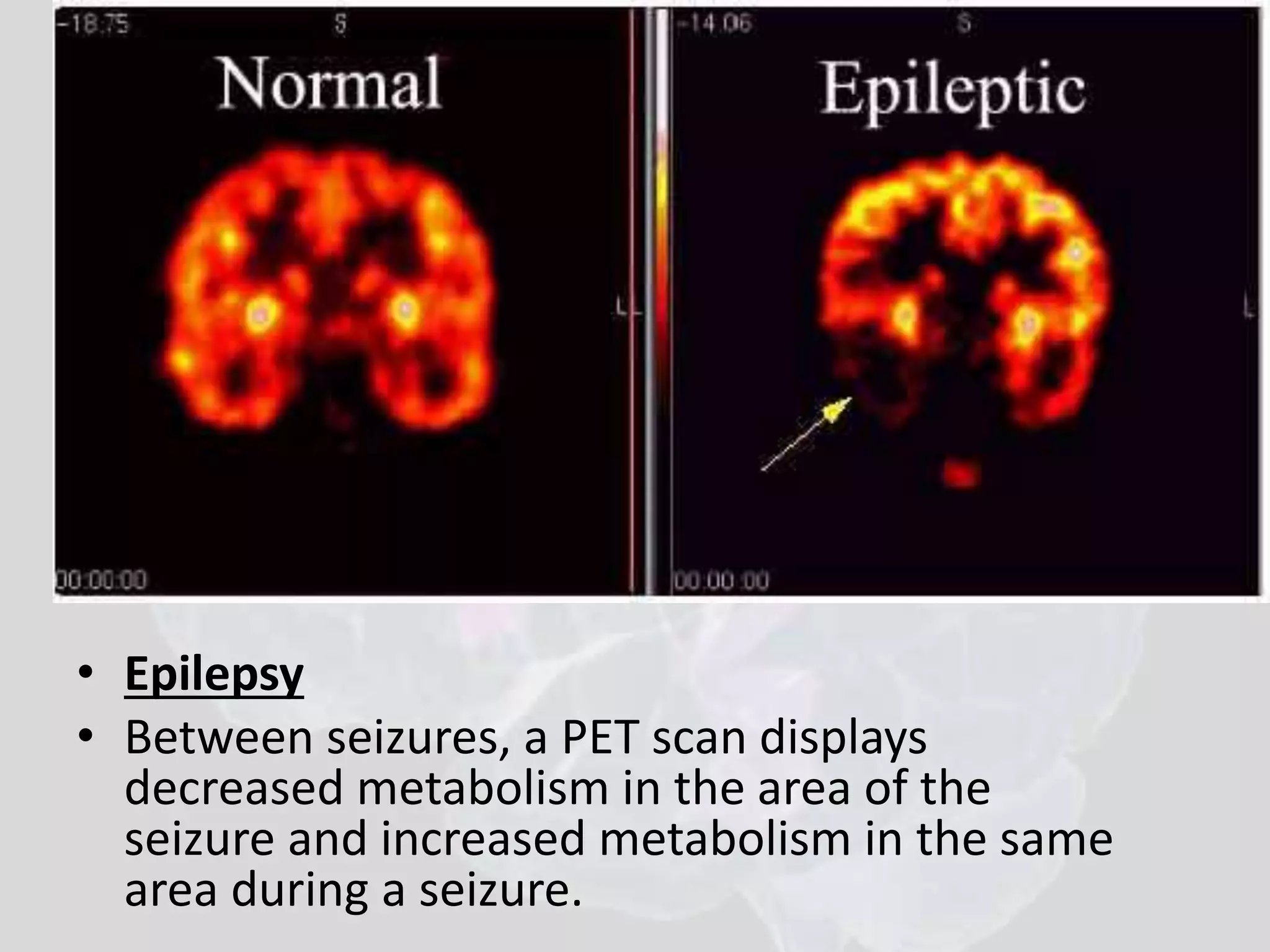 • Epilepsy 
• Between seizures, a PET scan displays 
decreased metabolism in the area of the 
seizure and increased metabolism in the same 
area during a seizure. 
 