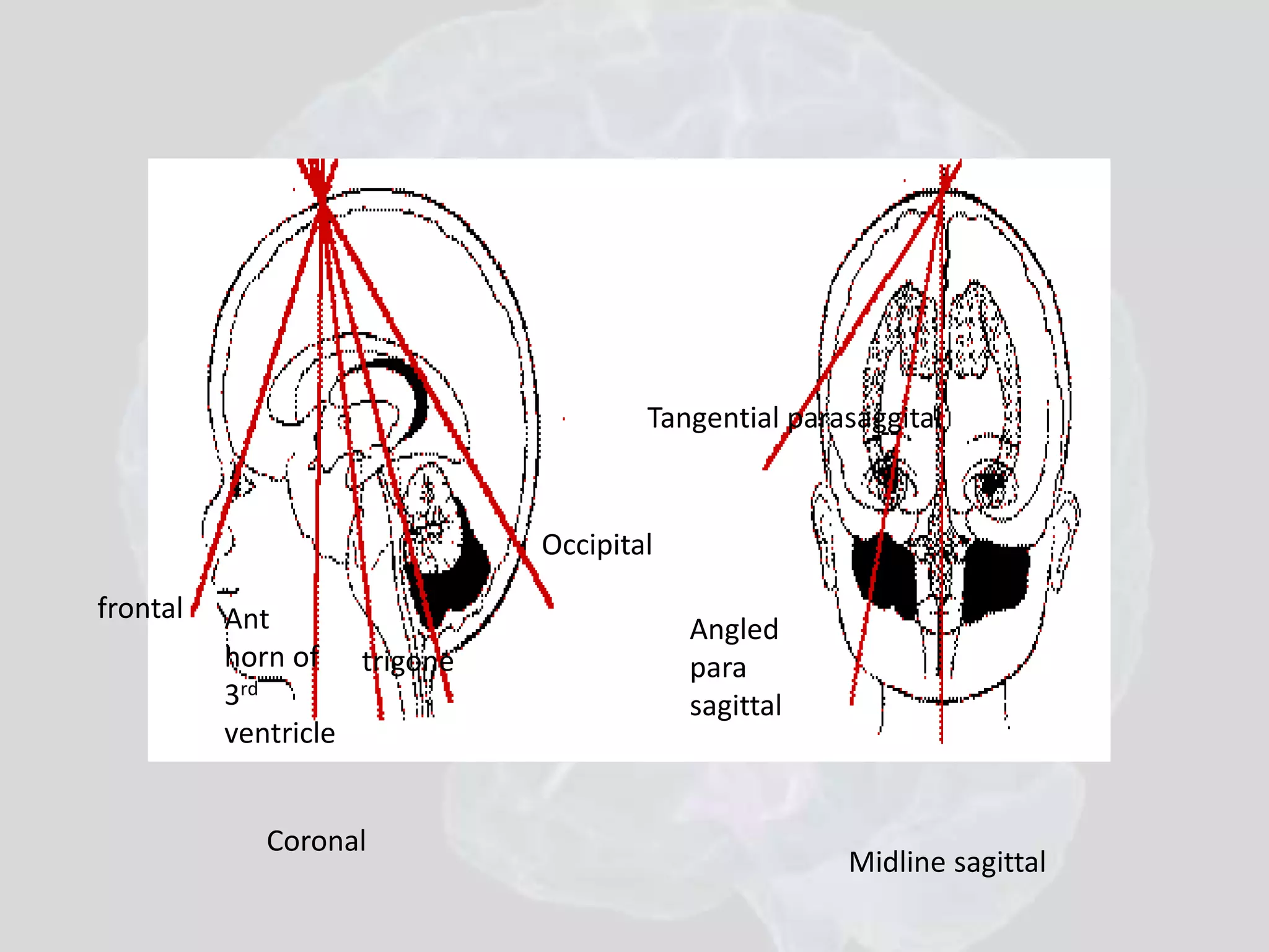 Coronal 
Tangential parasaggital 
Midline sagittal 
Angled 
para 
sagittal 
frontal Ant 
horn of 
3rd 
ventricle 
trigone 
Occipital 
 