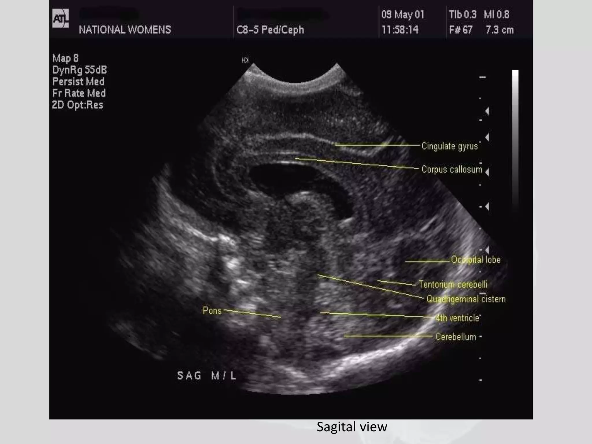 Cranial usg 
Sagital view 
 