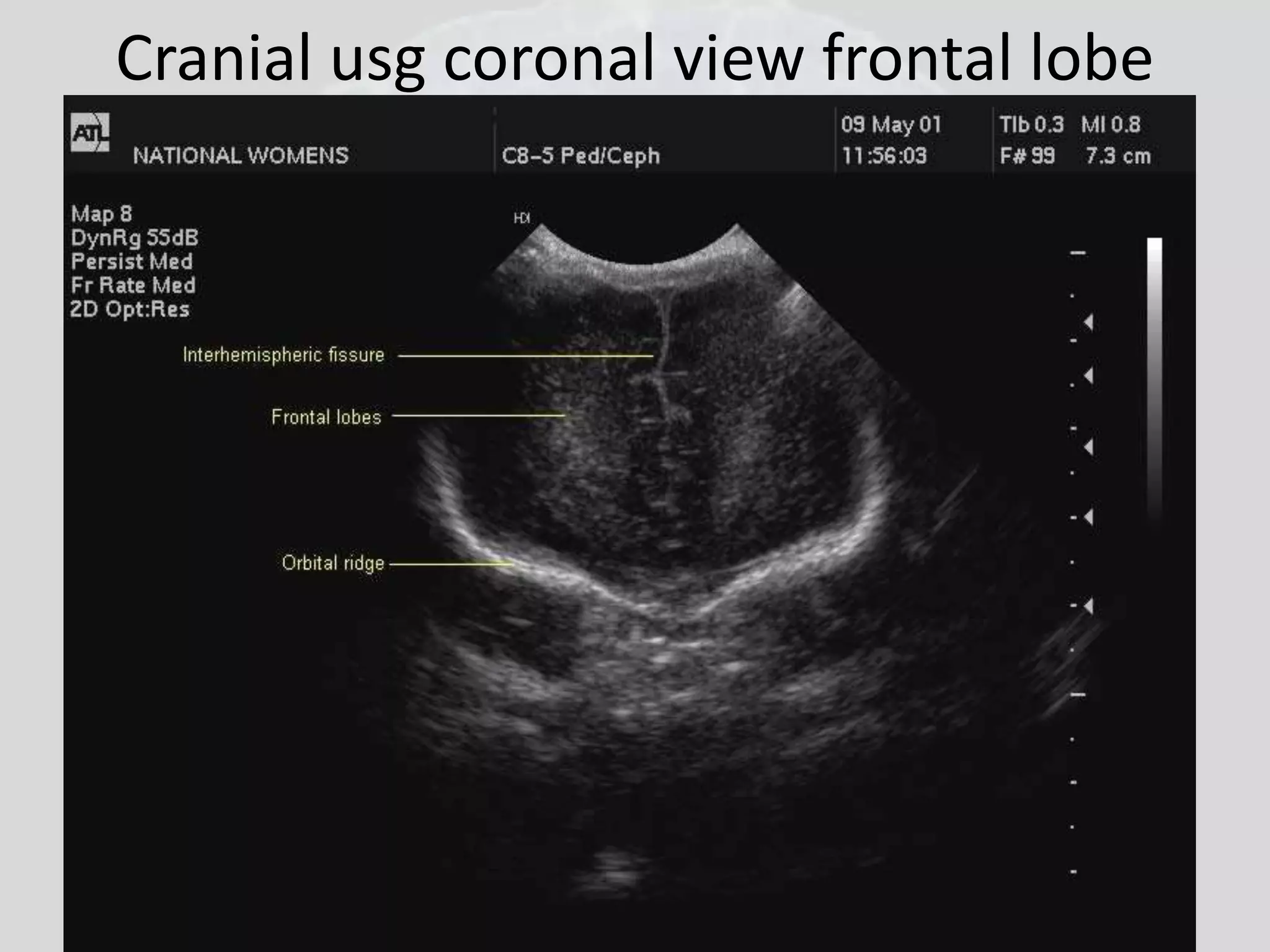Cranial usg coronal view frontal lobe 
 