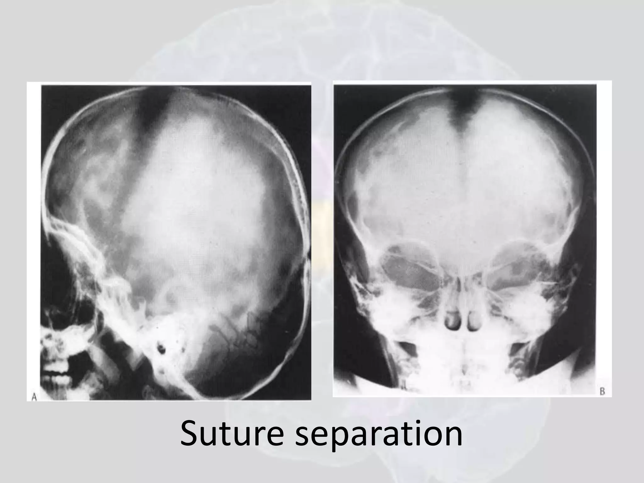 Suture separation 
 