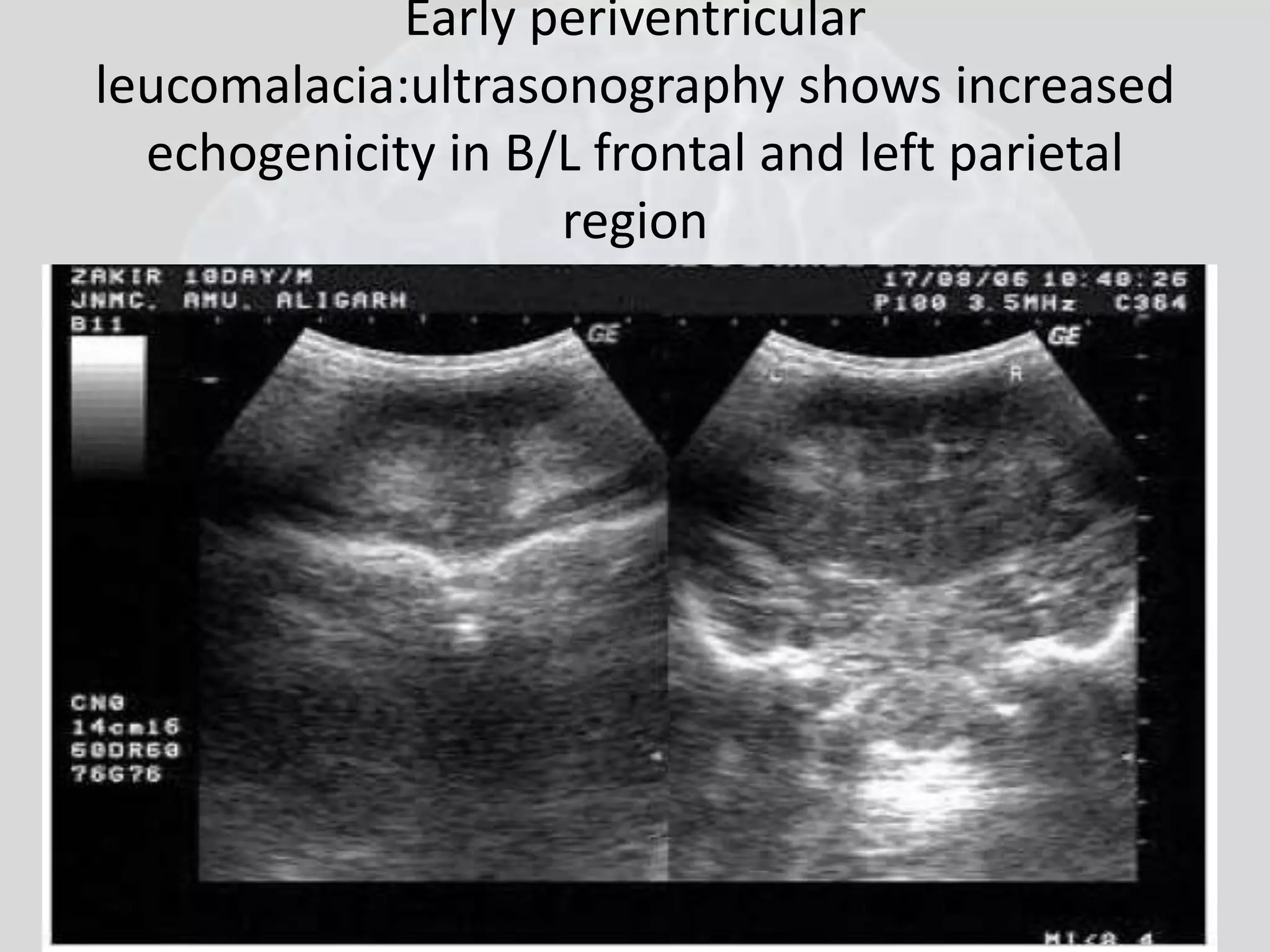 Early periventricular 
leucomalacia:ultrasonography shows increased 
echogenicity in B/L frontal and left parietal 
region 
 