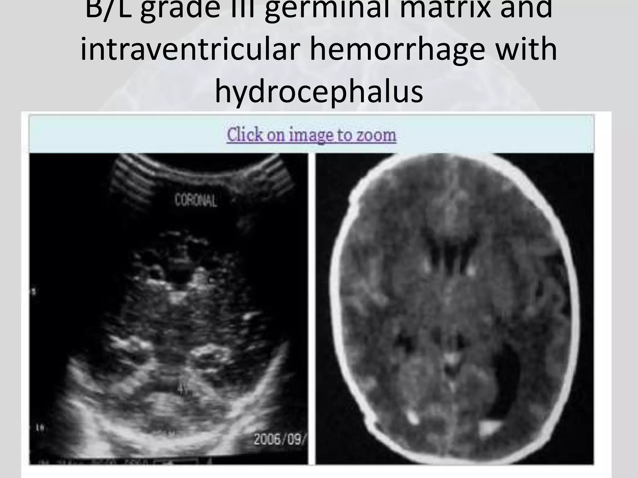 B/L grade III germinal matrix and 
intraventricular hemorrhage with 
hydrocephalus 
 