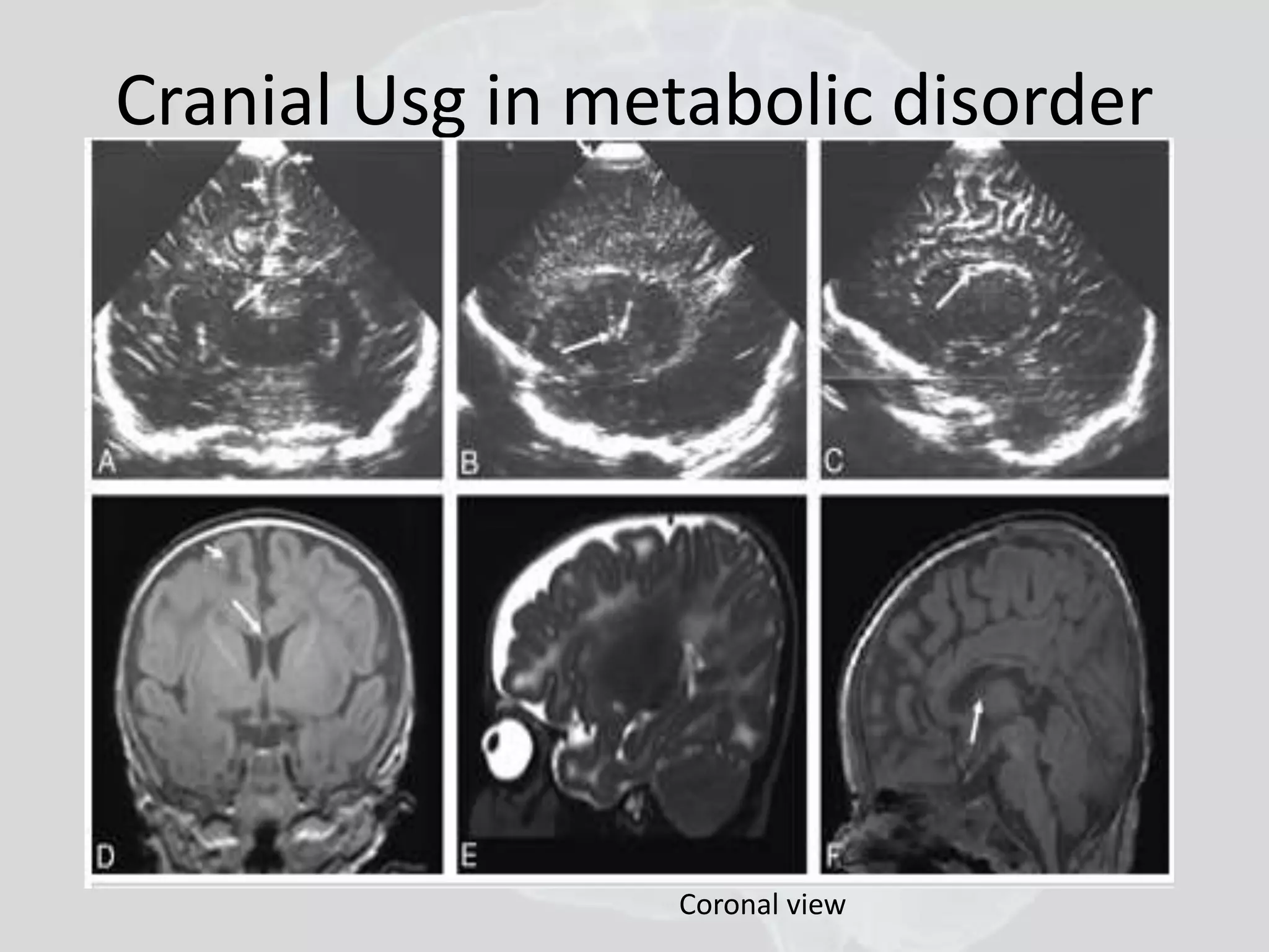 Cranial Usg in metabolic disorder 
Coronal view 
 