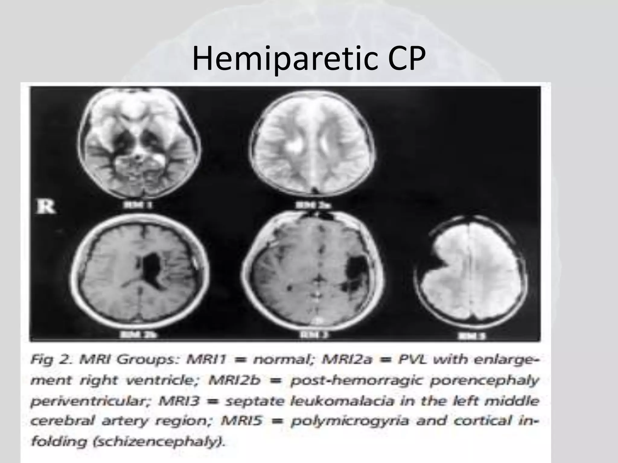 Hemiparetic CP 
 