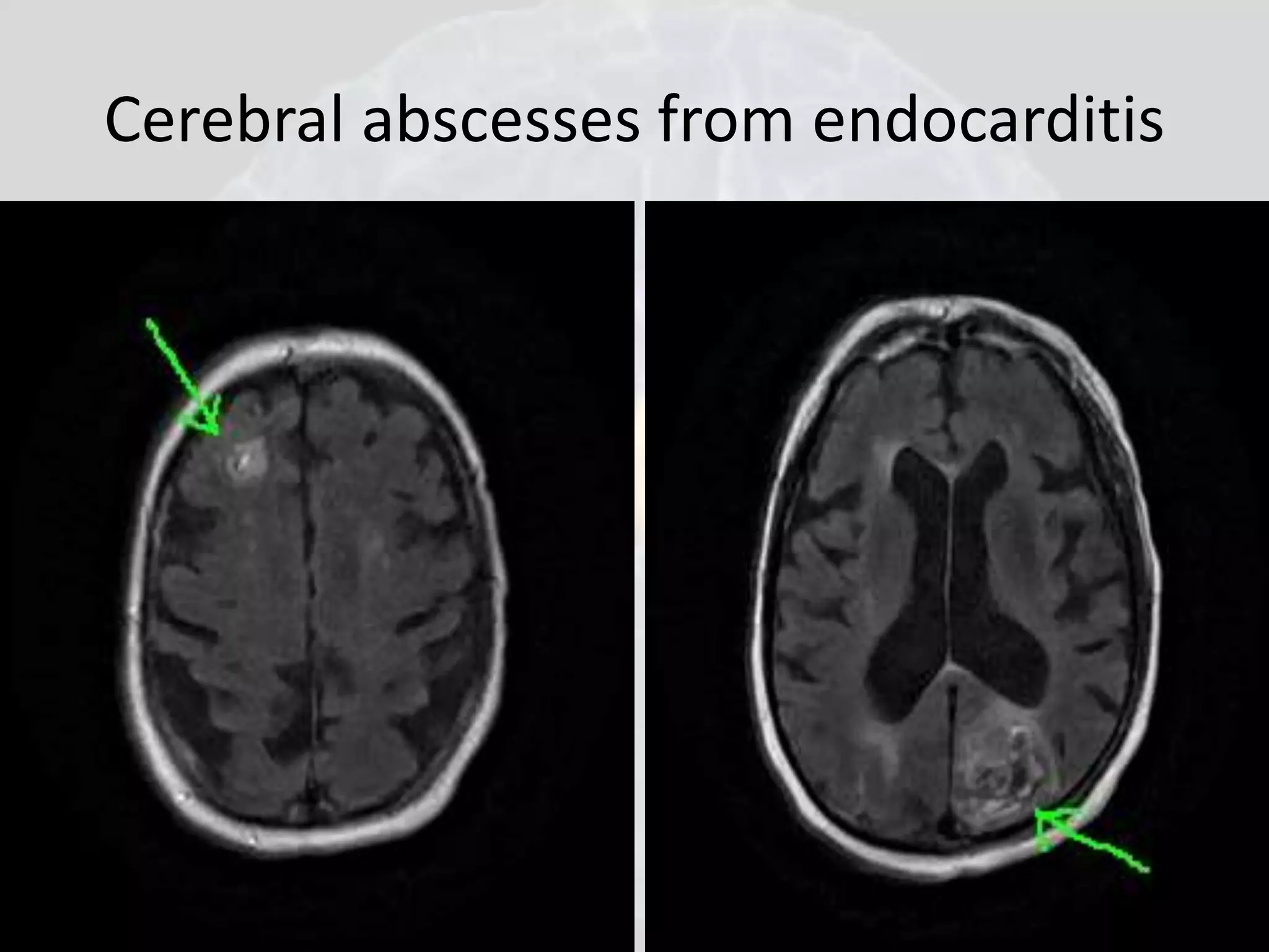 Cerebral abscesses from endocarditis 
 
