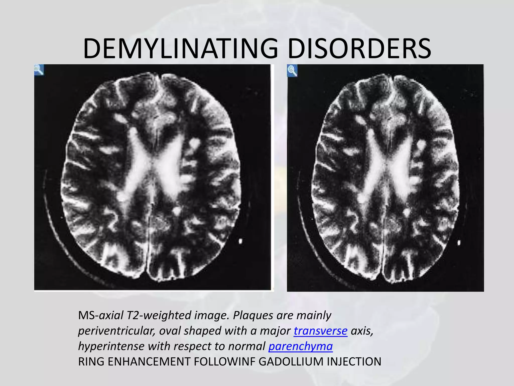 DEMYLINATING DISORDERS 
MS-axial T2-weighted image. Plaques are mainly 
periventricular, oval shaped with a major transverse axis, 
hyperintense with respect to normal parenchyma 
RING ENHANCEMENT FOLLOWINF GADOLLIUM INJECTION 
 