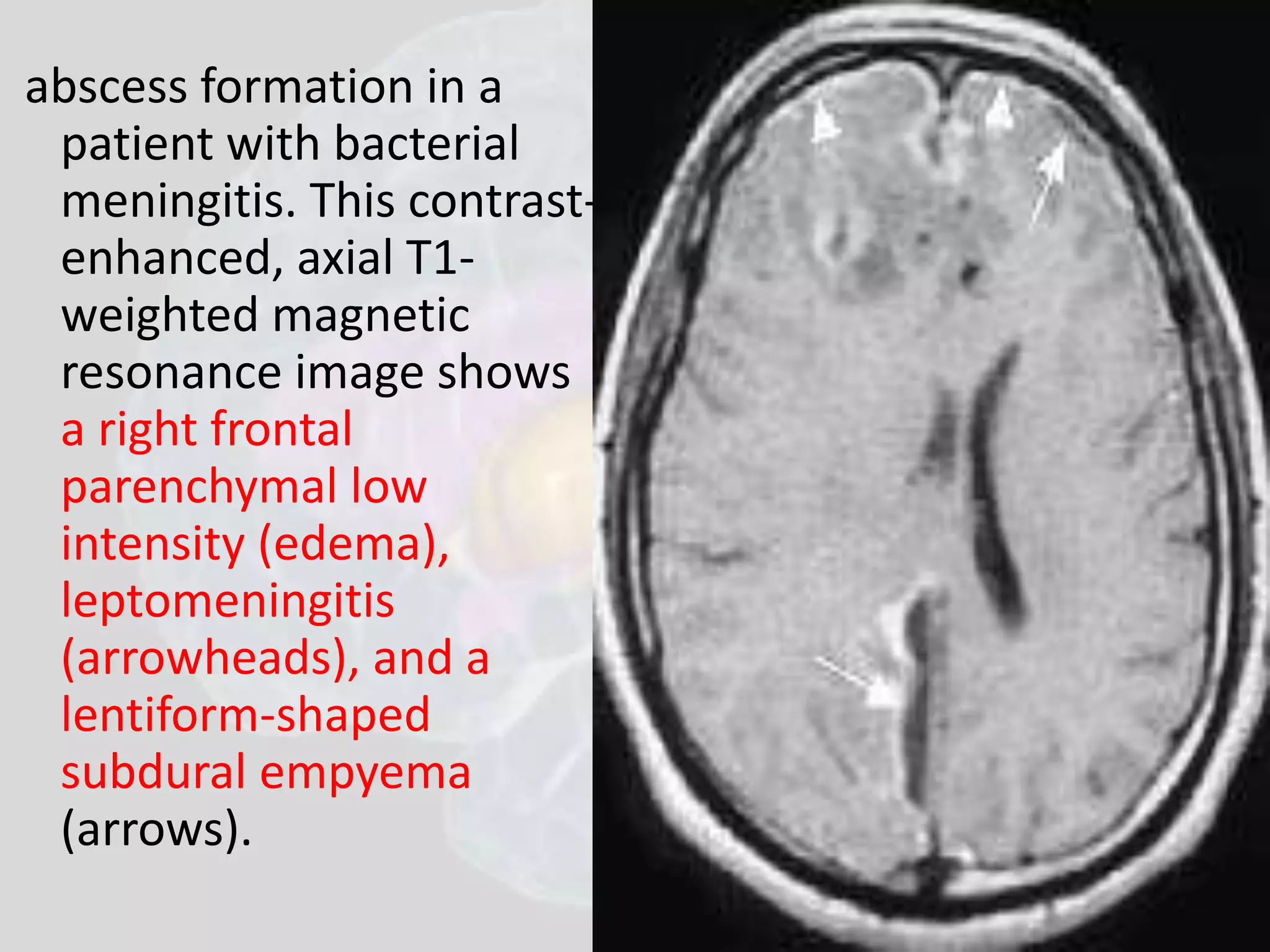 abscess formation in a 
patient with bacterial 
meningitis. This contrast-enhanced, 
axial T1- 
weighted magnetic 
resonance image shows 
a right frontal 
parenchymal low 
intensity (edema), 
leptomeningitis 
(arrowheads), and a 
lentiform-shaped 
subdural empyema 
(arrows). 
 