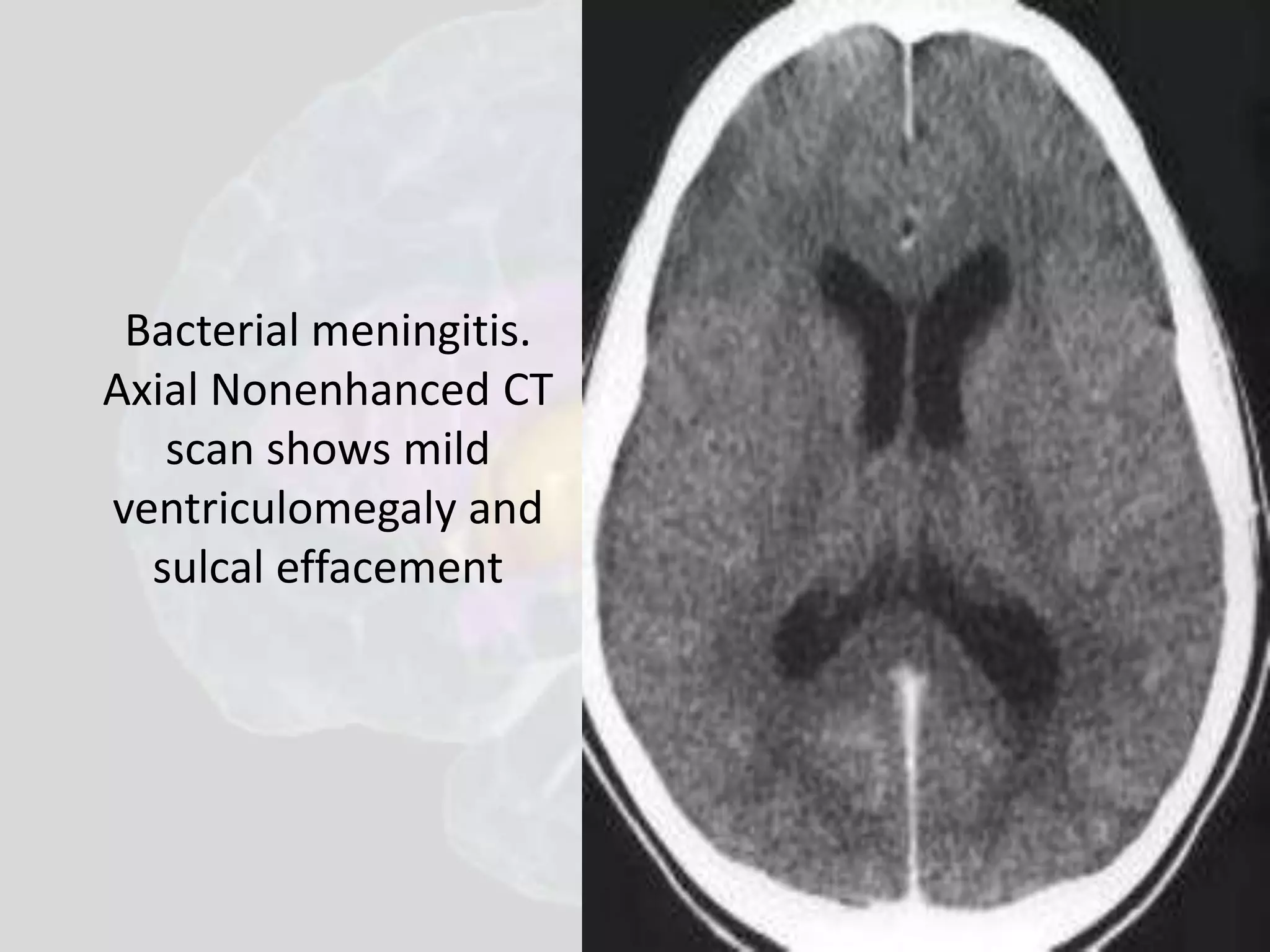 Bacterial meningitis. 
Axial Nonenhanced CT 
scan shows mild 
ventriculomegaly and 
sulcal effacement 
 