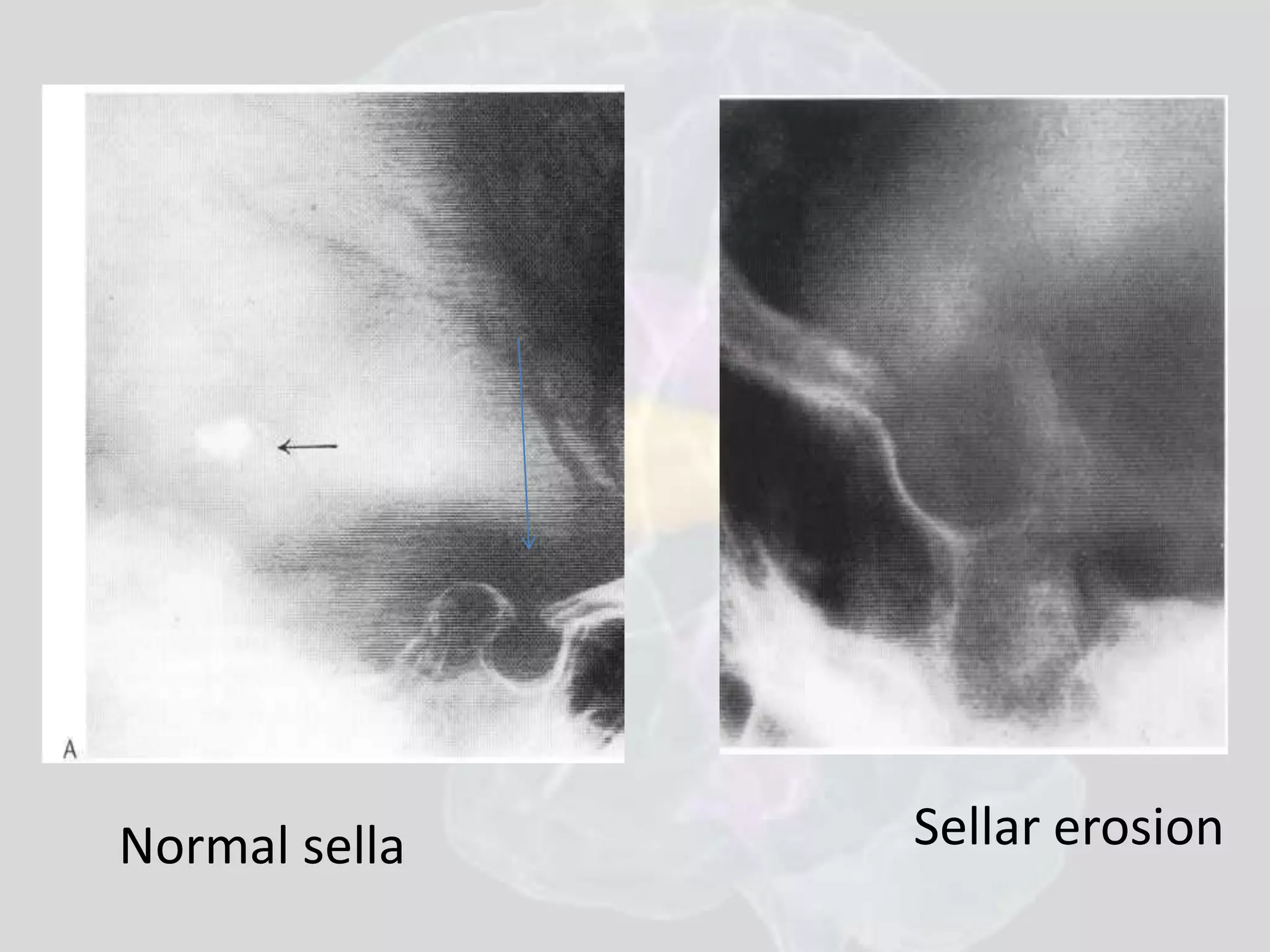 Normal sella Sellar erosion 
 
