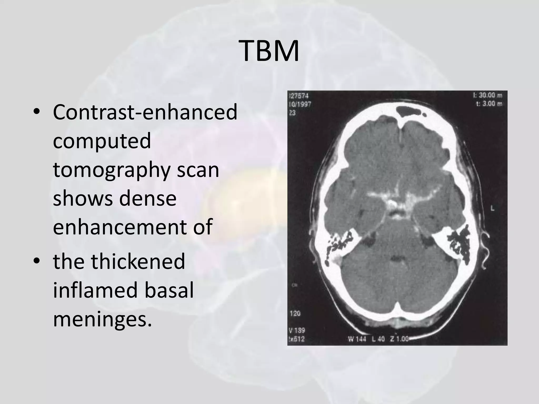 TBM 
• Contrast-enhanced 
computed 
tomography scan 
shows dense 
enhancement of 
• the thickened 
inflamed basal 
meninges. 
 