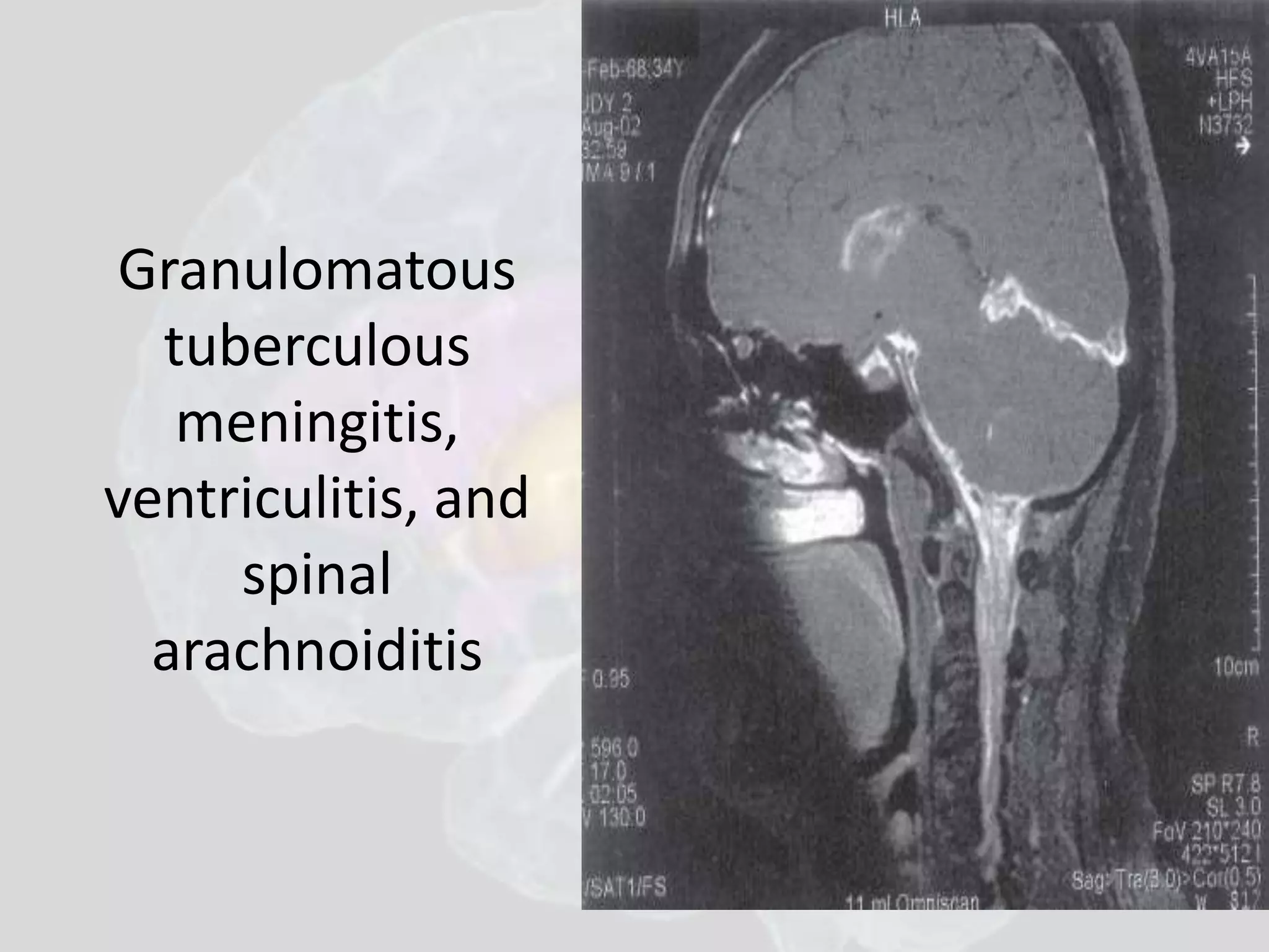 Granulomatous 
tuberculous 
meningitis, 
ventriculitis, and 
spinal 
arachnoiditis 
 