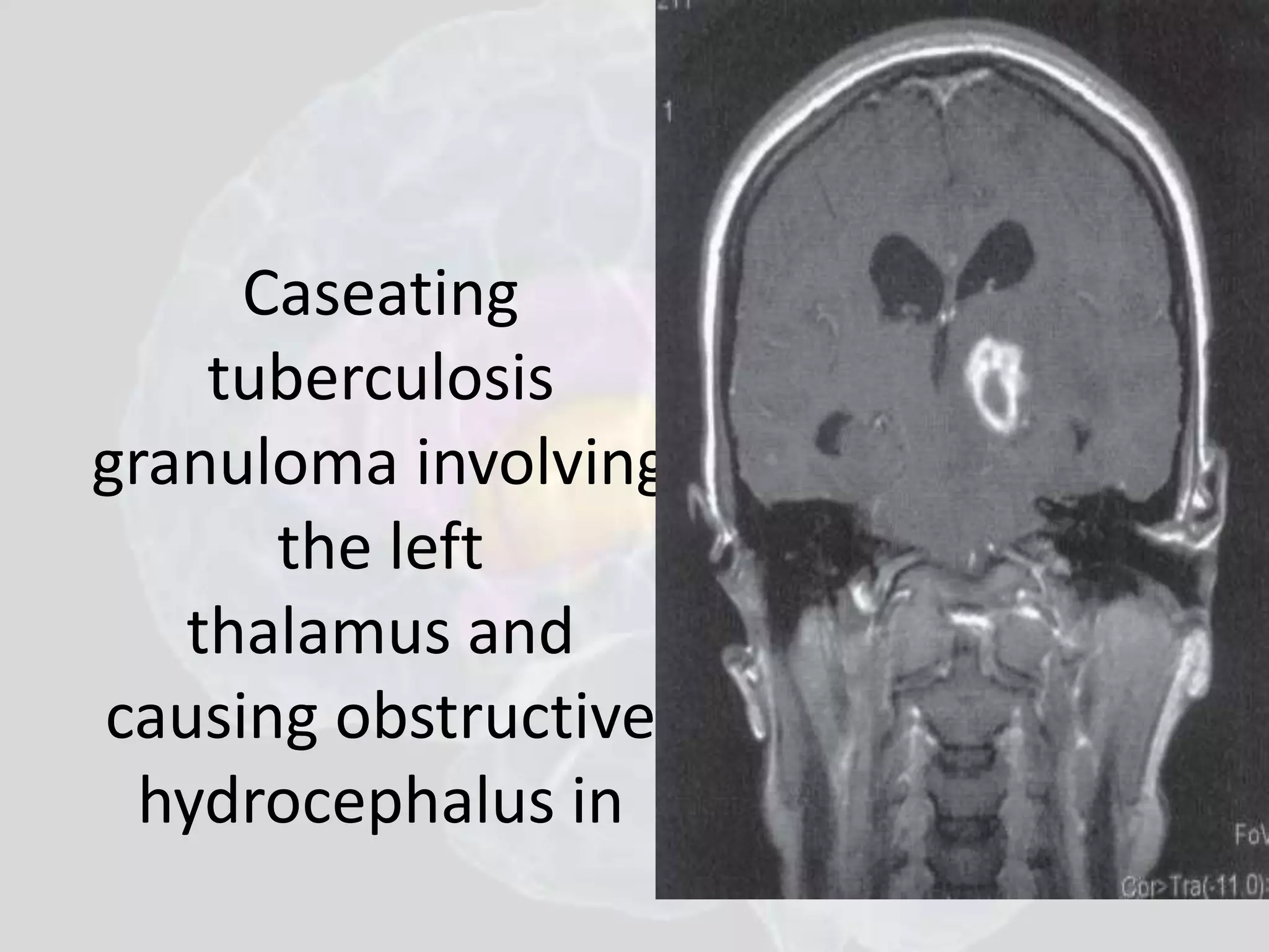 Caseating 
tuberculosis 
granuloma involving 
the left 
thalamus and 
causing obstructive 
hydrocephalus in 
 