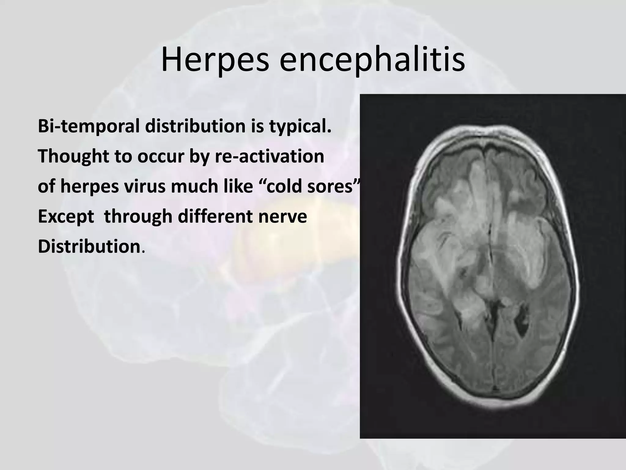 Herpes encephalitis 
Bi-temporal distribution is typical. 
Thought to occur by re-activation 
of herpes virus much like “cold sores” 
Except through different nerve 
Distribution. 
 