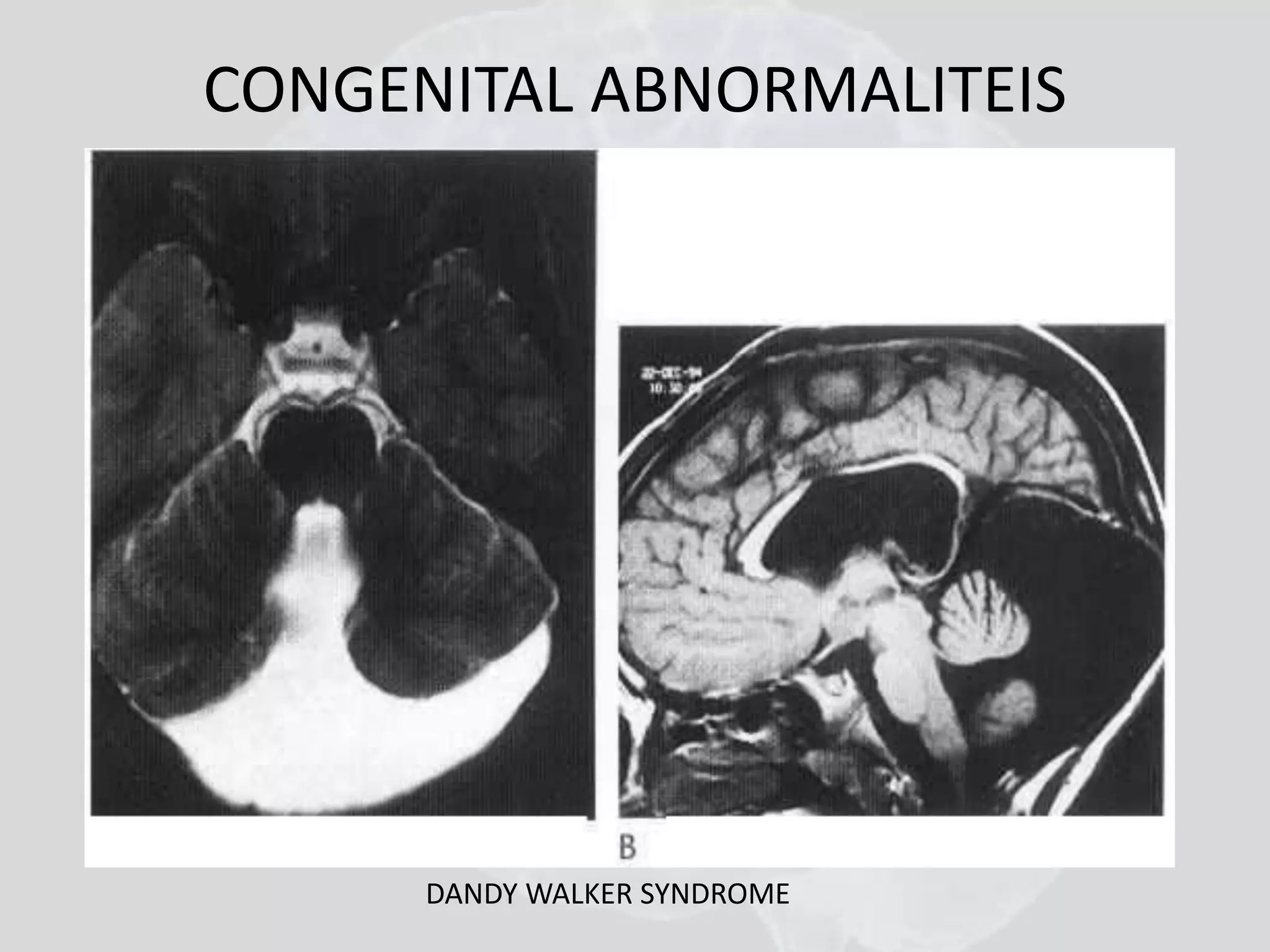 CONGENITAL ABNORMALITEIS 
DANDY WALKER SYNDROME 
 