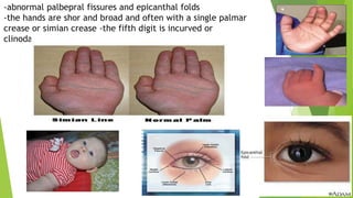 down syndrome 2 | PPTX