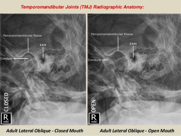 Presentation1.pptx, radiological anatomy of the temporo mandibular jo…