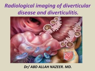Dr/ ABD ALLAH NAZEER. MD.
Radiological imaging of diverticular
disease and diverticulitis.
 