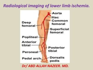 Radiological imaging of lower limb ischemia.
Dr/ ABD ALLAH NAZEER. MD.
 