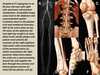 Presentation1.pptx, radiological imaging of lower limb ischemia. | PPTX