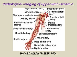 Radiological imaging of upper limb ischemia.
Dr/ ABD ALLAH NAZEER. MD.
 