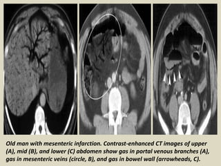 Mesenteric Infarction Radiopaedia Presentation1.pptx, radiological imaging of mesenteric ischemia. | PPTX