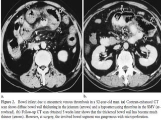Mesenteric Infarction Radiopaedia Presentation1.pptx, radiological imaging of mesenteric ischemia. | PPTX