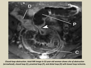 Presentation1.pptx, radiological imaging of mesenteric ischemia. | PPTX