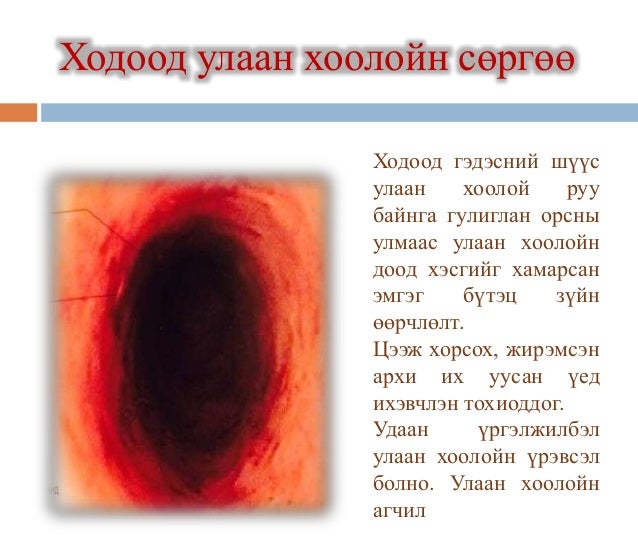 хоол боловсруулах замын эмгэг ба эмийн зохистой хэрэглээ
