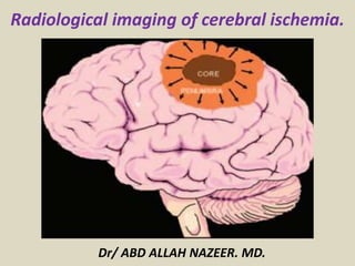 Radiological imaging of cerebral ischemia.
Dr/ ABD ALLAH NAZEER. MD.
 