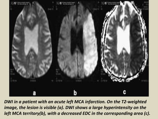 Presentation1.pptx, radiological imaging of cerebral ischemia. | PPTX