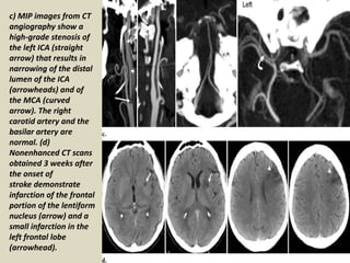 Ica Infarct Presentation1.pptx, radiological imaging of cerebral ischemia. | PPTX