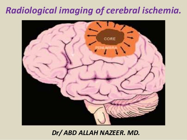 Presentation1 Pptx Radiological Imaging Of Cerebral Ischemia