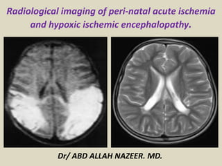 Radiological imaging of peri-natal acute ischemia
and hypoxic ischemic encephalopathy.
Dr/ ABD ALLAH NAZEER. MD.
 