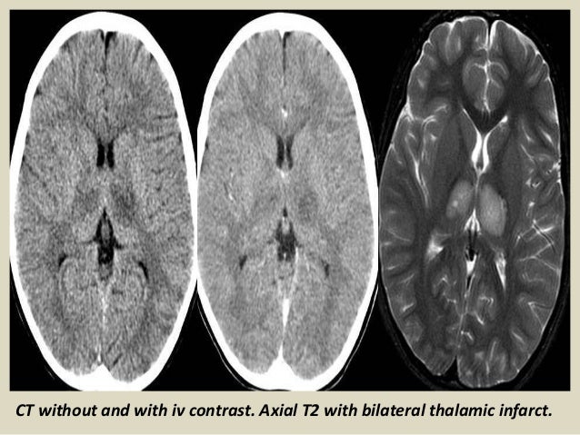 Peri Infarct Ischemia : Myocardial Ischemia: Causes, Symptoms and ...