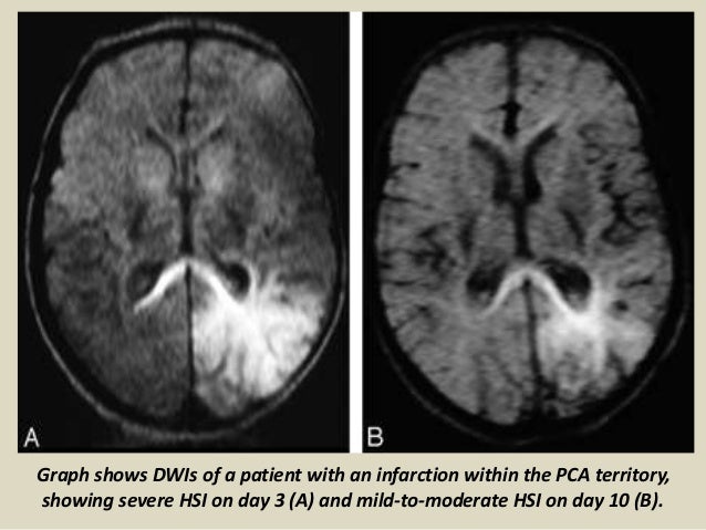Peri Infarct Ischemia : Myocardial Ischemia: Causes, Symptoms and ...