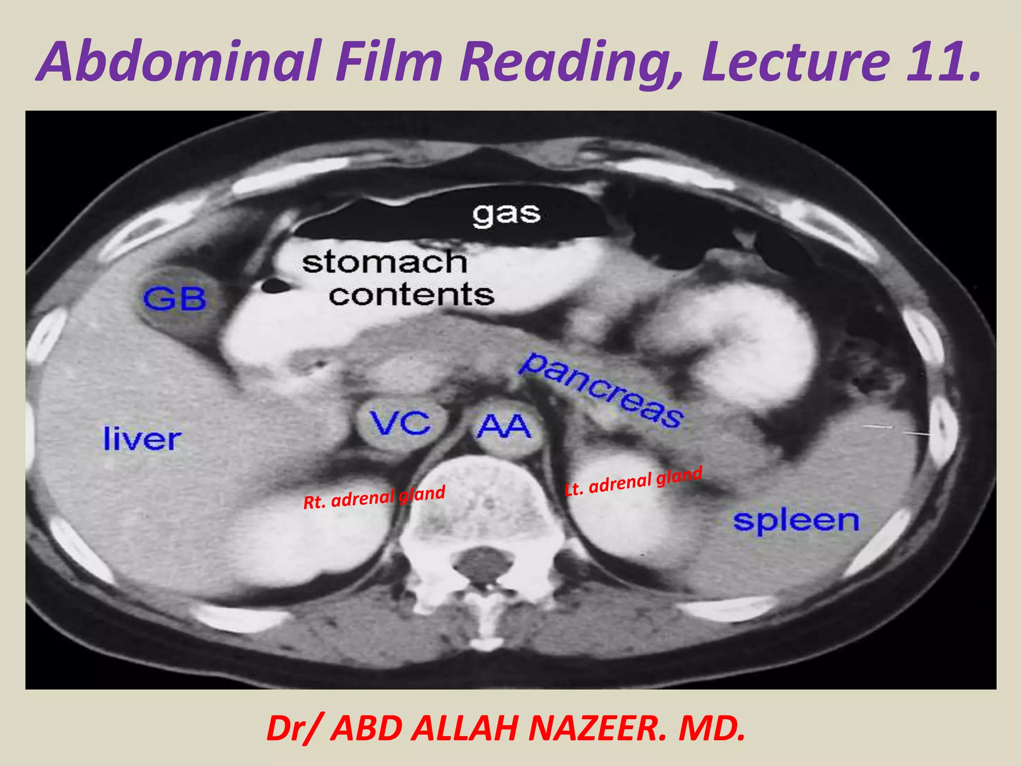 Presentation1.pptx, abdominal film reading, lecture 11. | PPTX