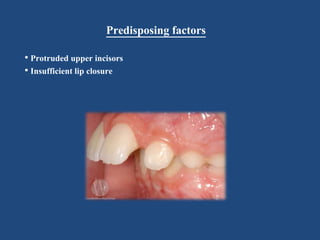 Predisposing factors
• Protruded upper incisors
• Insufficient lip closure
 
