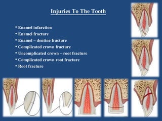 Injuries To The Tooth
• Enamel infarction
• Enamel fracture
• Enamel – dentine fracture
• Complicated crown fracture
• Uncomplicated crown – root fracture
• Complicated crown root fracture
• Root fracture
 